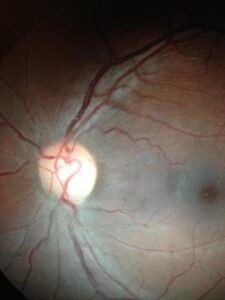 heart optic nerve