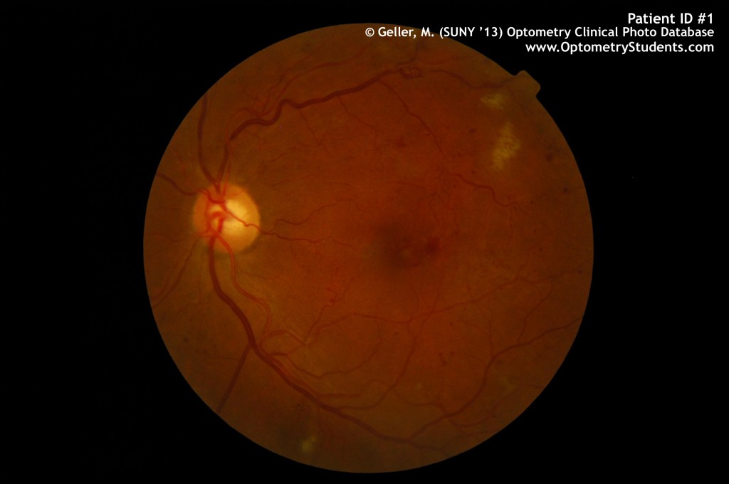 A case of severe non-proliferative diabetic retinopathy.
