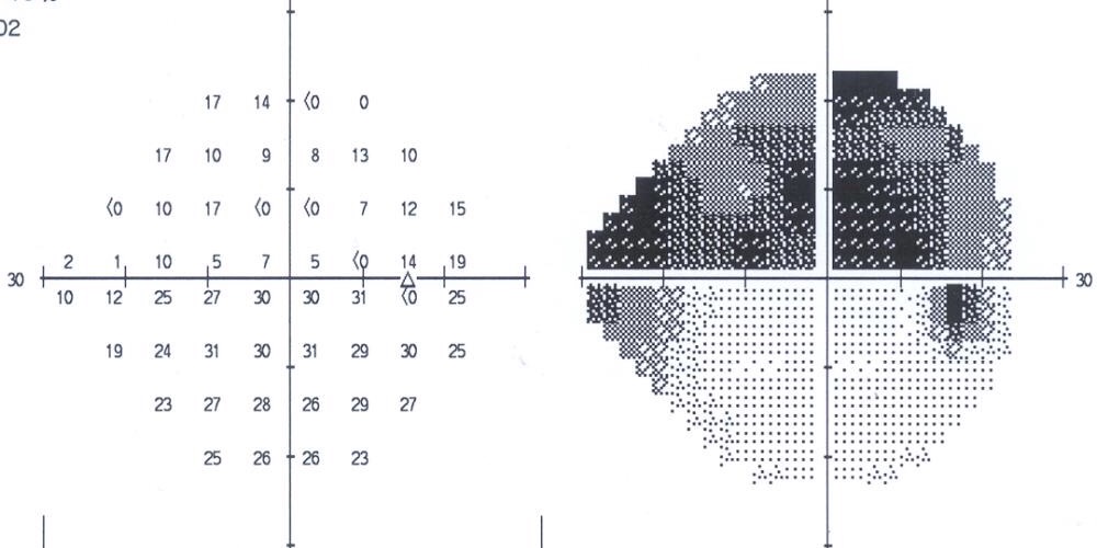 Visual Field Test Chart