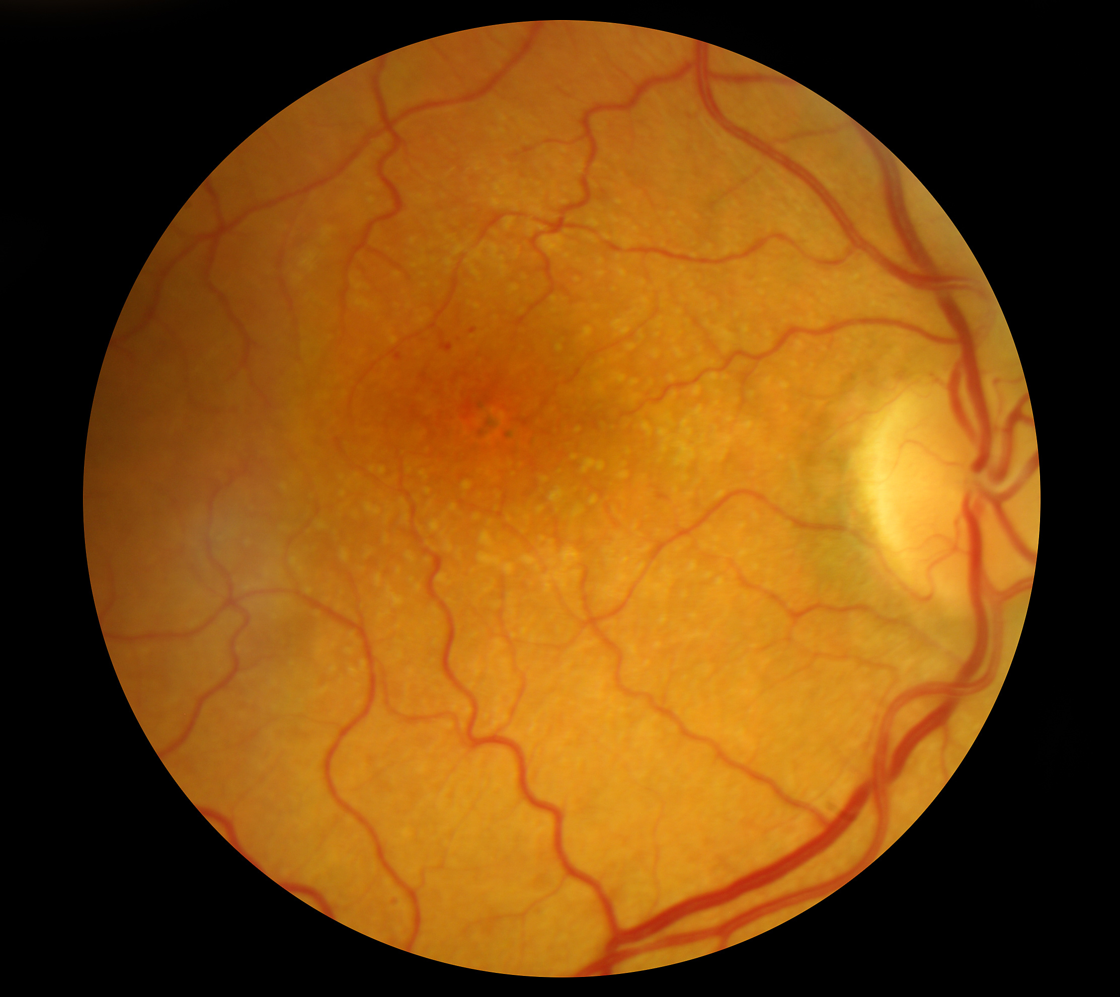 Medical Fundus photo of retinal pathology, hemmorhages, vein occ