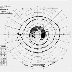 Visual Field Chart Interpretation