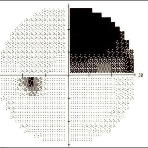 Visual Field Chart Interpretation