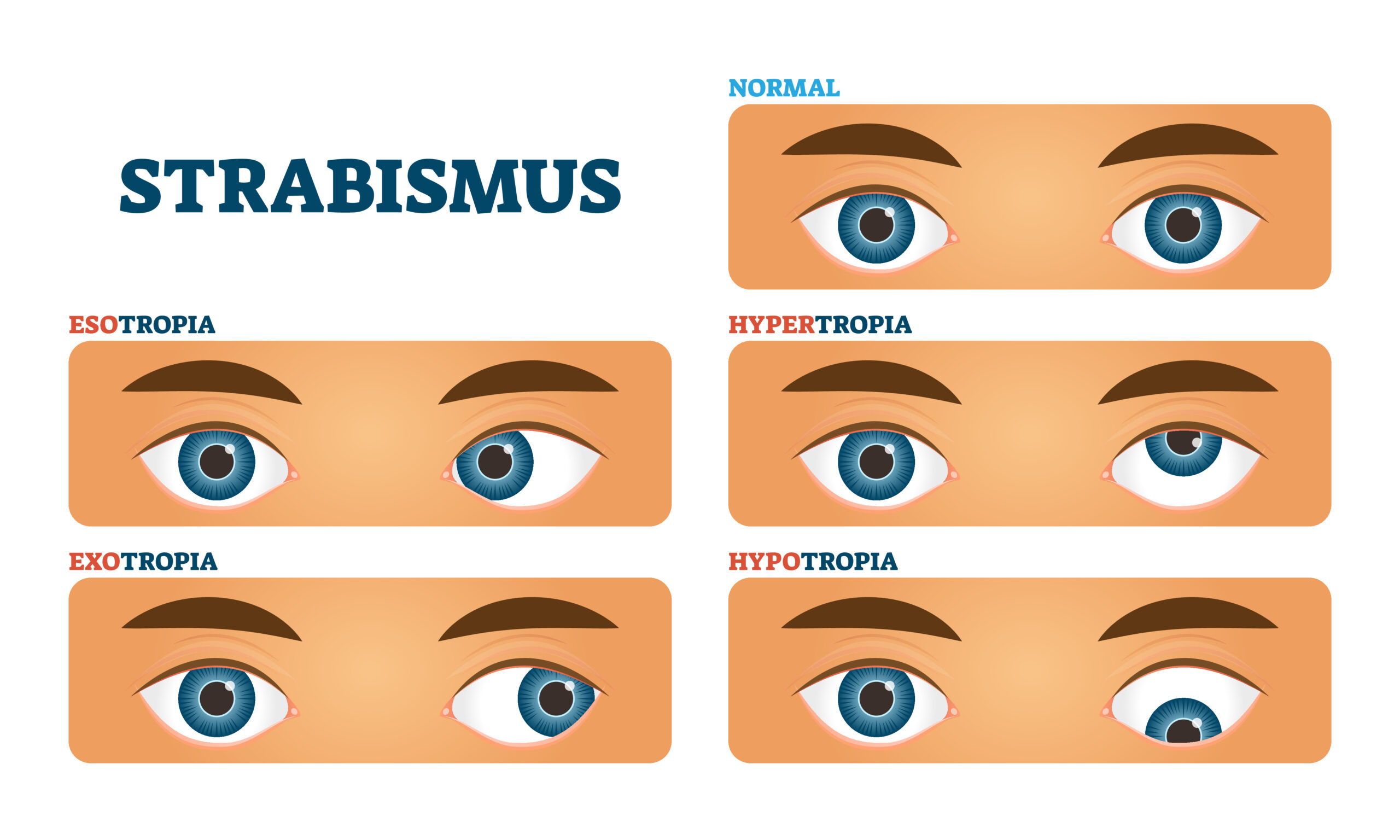 strabism oftalmologic)