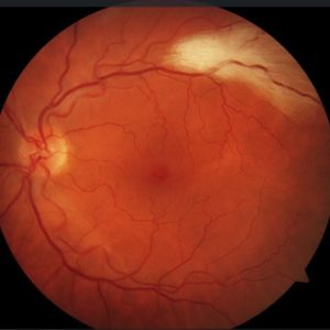 myelinated nerve fiber, retina, optometry